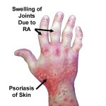 psoriaticarthritissymptoms3