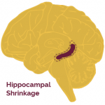 atrophied-hippocampus_0